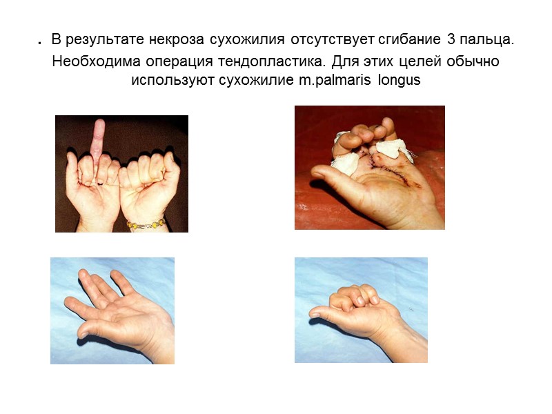 . В результате некроза сухожилия отсутствует сгибание 3 пальца. Необходима операция тендопластика. Для этих